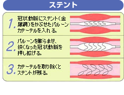 ステント