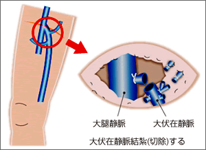 下肢静脈高位結紮(こういけっさつ)術