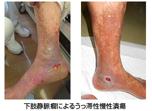 下肢静脈瘤に対する血管内焼灼術の実施基準による実施医